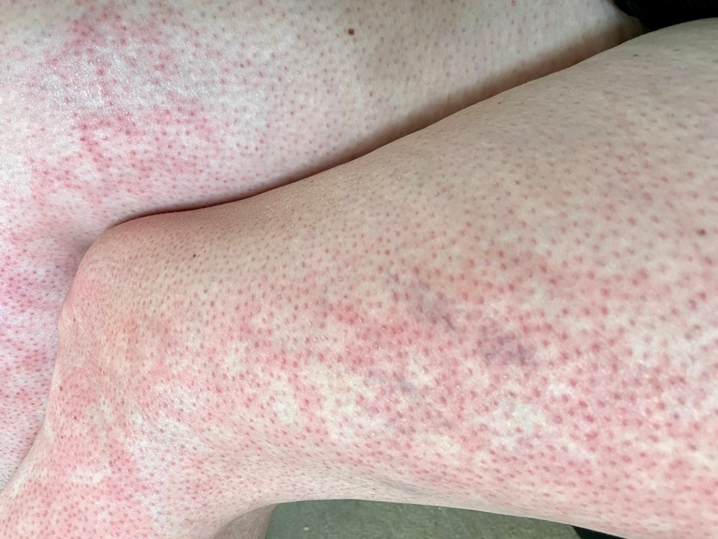 The classic symptom of erythema ab igne is a rash that resembles a fishnet or "like lace" model.